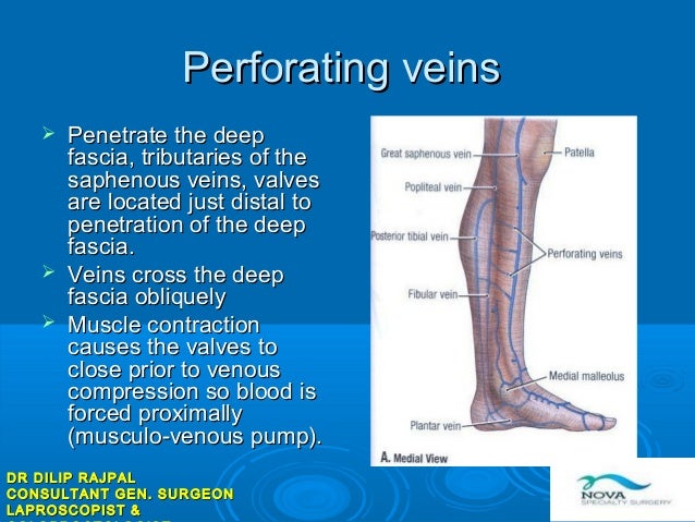Endovenous laser ablation