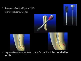 • InstrumentRemoval System (I.R.S.)
Microtube & Screw wedge
• Separated InsrumentRetrieval(S.I.R.)- Extractor tube bonded to
obstr
 