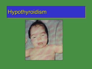 Hypothyroidism 