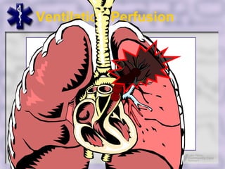 Ventilation:Perfusion
 
