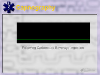 Capnography




 Following Carbonated Beverage Ingestion
 