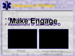 Adequacy of Resps


  Make Engage
• Easy to recognize apnea
• Assessment of asthma/COPD




     Normal      Airway Obstruction
                  (Bronchospasm)
 