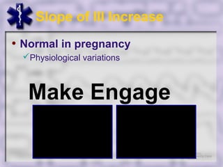 Slope of III Increase
• Normal in pregnancy
 Physiological variations



  Make Engage
 