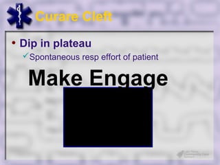 Curare Cleft
• Dip in plateau
  Spontaneous resp effort of patient


   Make Engage
 