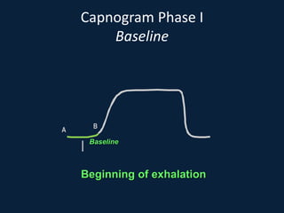 Capnogram Phase I
Baseline
Beginning of exhalation
A
B
I Baseline
 