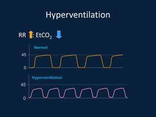 45
0
Hyperventilation
RR : EtCO2
45
0
Normal
Hyperventilation
 