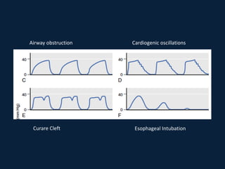 Airway obstruction Cardiogenic oscillations
Curare Cleft Esophageal Intubation
 