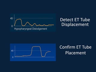 Detect ET Tube
Displacement
Confirm ET Tube
Placement
 