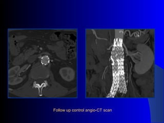 Follow up control angio-CT scan
 