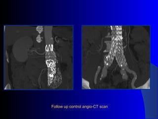 Follow up control angio-CT scan
 