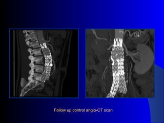 Follow up control angio-CT scan
 