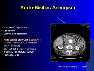 Aorto-Bisiliac AneurysmAorto-Bisiliac Aneurysm
v S. A., male, 72 years old
v Dyslipidemia
v Carotid atherosclerosis
v Aorto-Bisiliac Stent Graft ENDURANT
(ENBF2816C145EE, ENLW1624C120EE,
ENLW1620C80EE)
v Bilateral Bell Bottom Technique
v 4 Coils (Cook IMWCE 35 20 20)
Fibrin glue 7 cc
Pre-surgery angio-CT scan
 