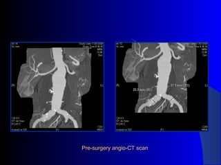 Pre-surgery angio-CT scan
 