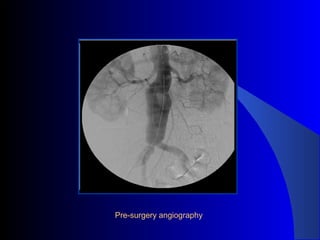 Pre-surgery angiography
 