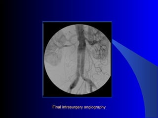 Final intrasurgery angiography
 