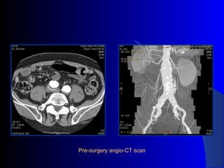 Pre-surgery angio-CT scan
 