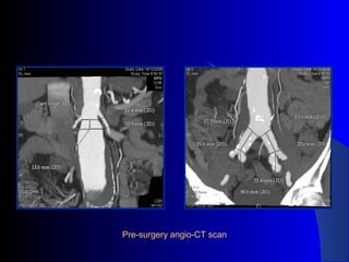 Pre-surgery angio-CT scan
 