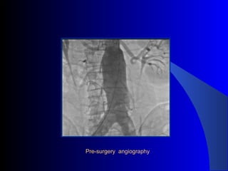 Pre-surgery angiography
 