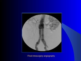 Final intrasurgery angiography
 