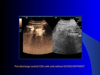 Pre-discharge control CDU with and without ECHOCONTRAST
 