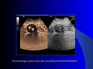 Pre-discharge control CDU with and without ECHOCONTRAST
 