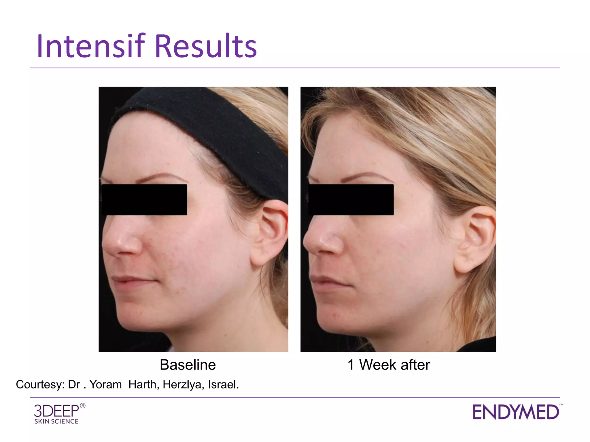 Matrix Pro Rfmn INTENSIF RFMN Before and Afters | PDF