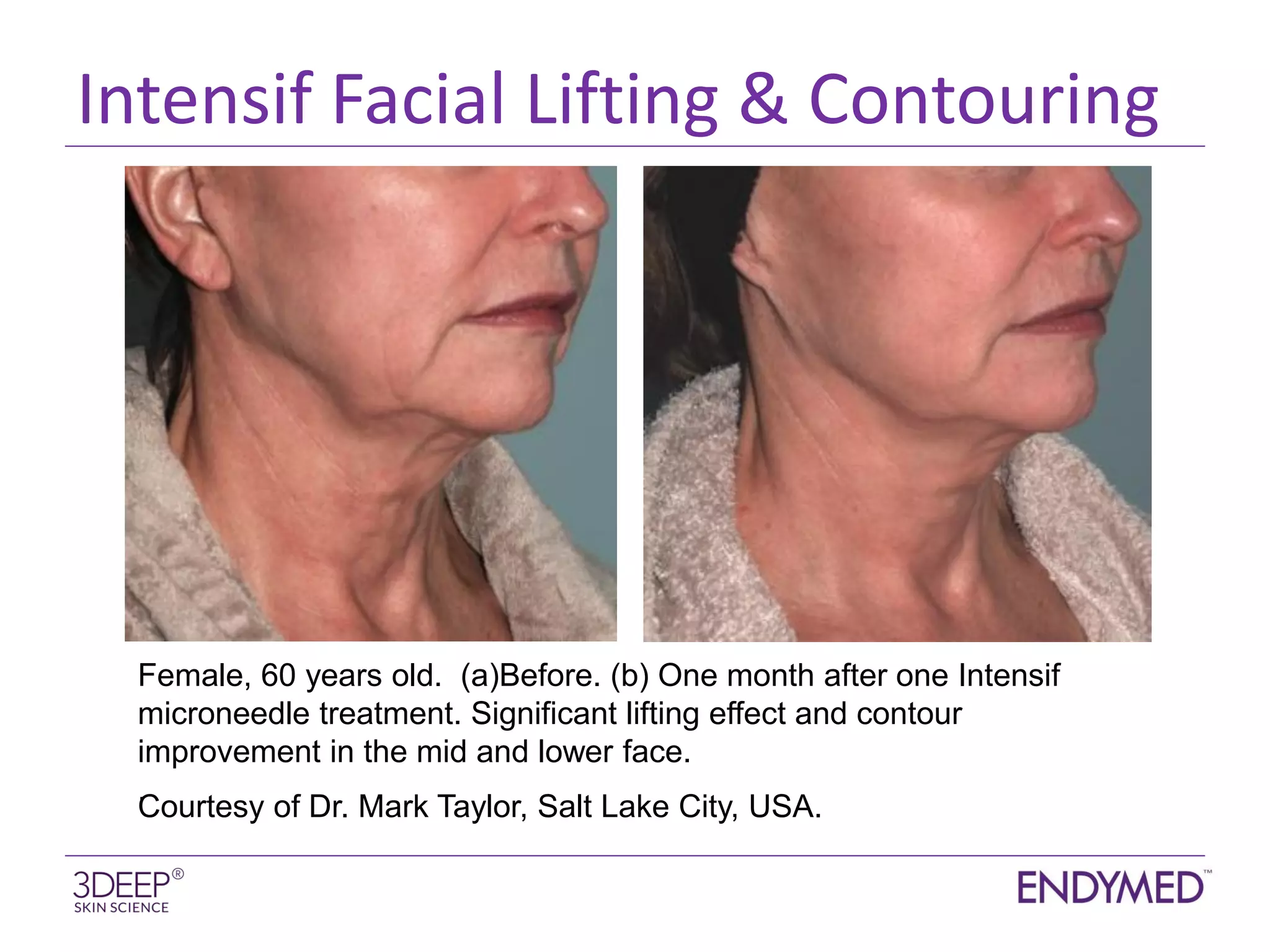 INTENSIF RFMN Before and Afters | PDF