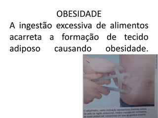 OBESIDADE
A ingestão excessiva de alimentos
acarreta a formação de tecido
adiposo causando obesidade.
 