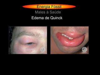Energia Fóssil
 Males à Saúde
Edema de Quinck
 