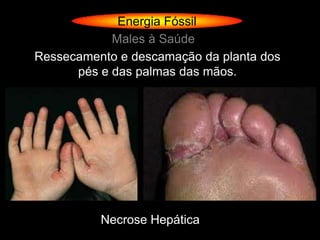 Energia Fóssil
            Males à Saúde
Ressecamento e descamação da planta dos
      pés e das palmas das mãos.




          Necrose Hepática
 