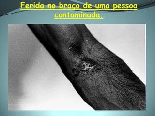 Ferida no braço de uma pessoa
         contaminada.
 