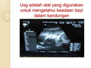 Usg adalah alat yang digunakan
untuk mengetahui keadaan bayi
dalam kandungan

 