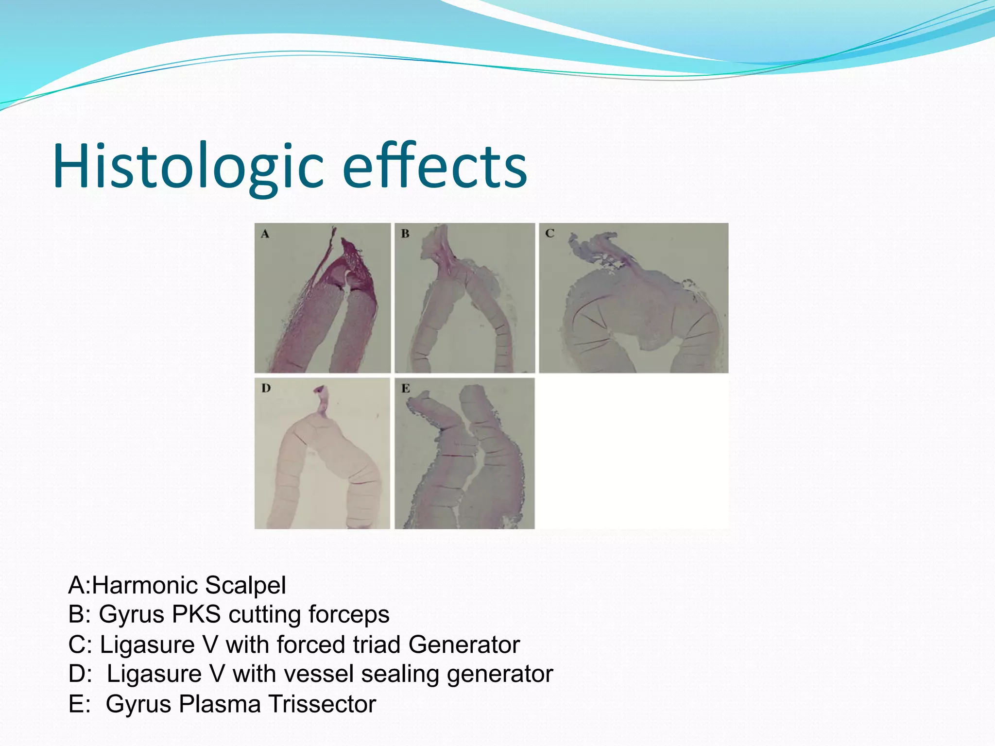 Histologic	
  eﬀects	
  
A:Harmonic Scalpel
B: Gyrus PKS cutting forceps
C: Ligasure V with forced triad Generator
D: Ligasure V with vessel sealing generator
E: Gyrus Plasma Trissector
 