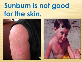 Sunburn is not good
for the skin.
 