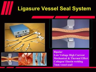 Ligasure Vessel Seal SystemLigasure Vessel Seal System
Bipolar
Low Voltage High Current
Mechanical & Thermal Effect
Collagen/ Elastin welding
7mm vessel seal!
 