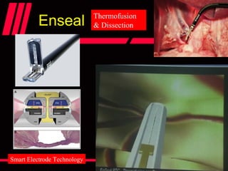 Enseal Thermofusion
& Dissection
Smart Electrode Technology
 