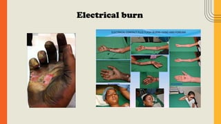 Electrical burn
 
