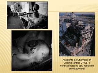 Accidente de Chernóbil en
Ucrania (antiga URSS) e
nenos afectados pola radiación
en estado fetal
 
