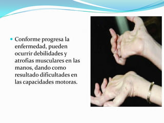  Conforme progresa la
enfermedad, pueden
ocurrir debilidades y
atrofias musculares en las
manos, dando como
resultado dif...
