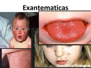 Exantematicas
Dra. Gilda Tamagno
 