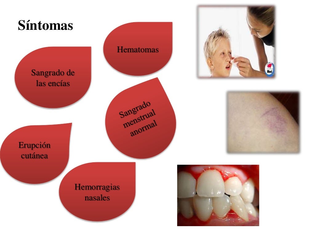 Enfermedad de von willebrand