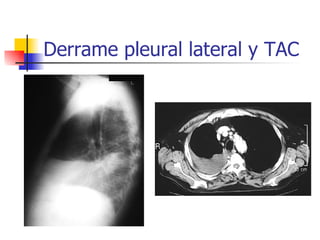 Derrame pleural lateral y TAC 