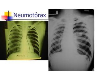 Neumotórax 