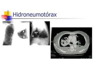 Hidroneumotórax 