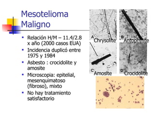 Mesotelioma  Maligno Relación H/M – 11.4/2.8 x año (2000 casos EUA) Incidencia duplicó entre 1975 y 1984 Asbesto : crocidolite y amosite Microscopia: epitelial, mesenquimatoso (fibroso), mixto No hay tratamiento satisfactorio Chrysolite  Antophylite Amosite  Crocidolite 