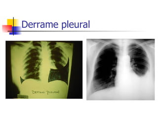 Derrame pleural 