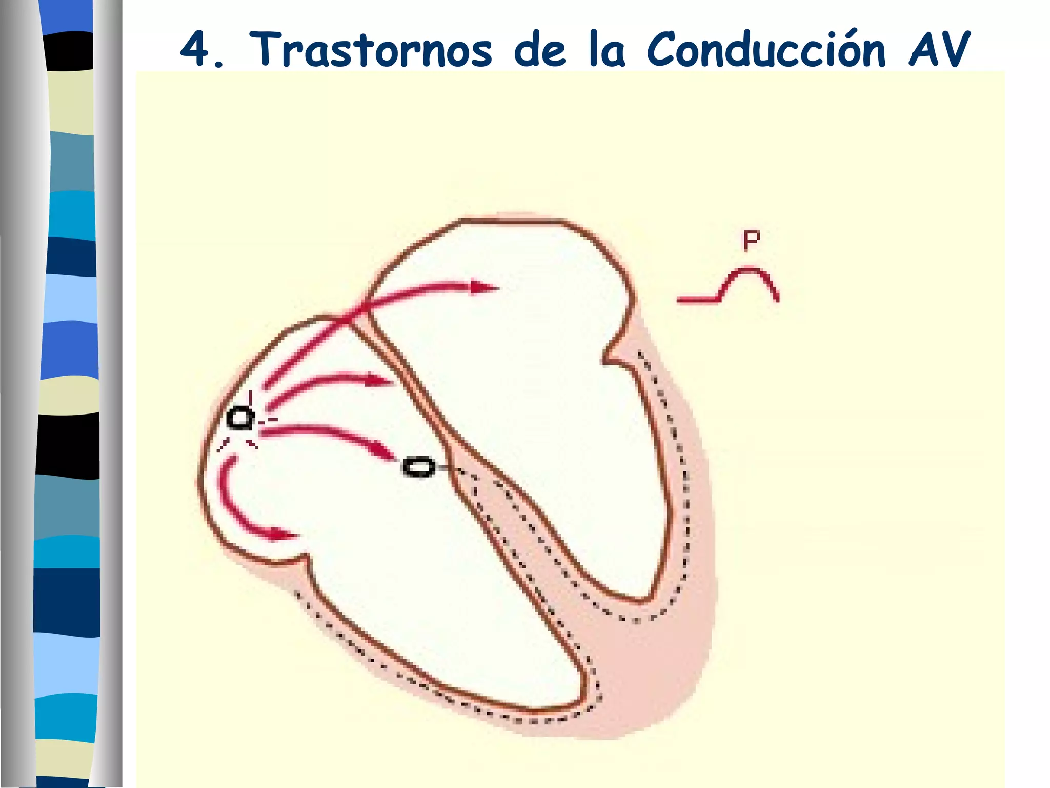 4. Trastornos de la Conducción AV 