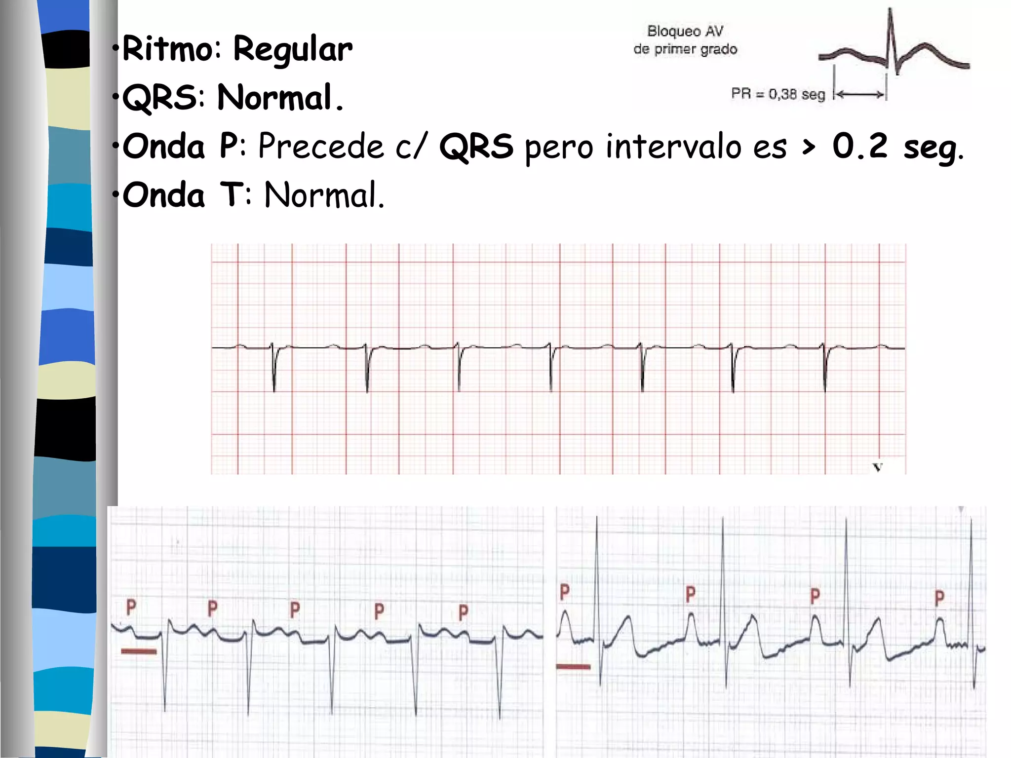Ritmo :  Regular QRS :  Normal. Onda P : Precede c/  QRS  pero intervalo es  > 0.2 seg . Onda T : Normal. 