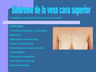 Causado por la oclusión de la vena cava superior
ETIOLOGIA
Tumores bronquiales y pulmonares
Metástasis
Adenopatías mediastínicas
Fibrosis mediastínicas
Aneurismas de la aorta torácica
Tromboflebitis
Pericarditis constrictiva
Traumatismos externos
Formas idiopáticas
 