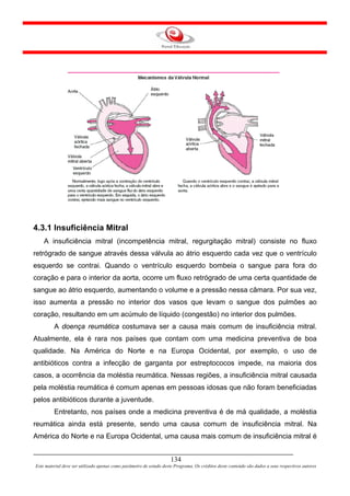 4.3.1 Insuficiência Mitral
    A insuficiência mitral (incompetência mitral, regurgitação mitral) consiste no fluxo
retrógrado de sangue através dessa válvula ao átrio esquerdo cada vez que o ventrículo
esquerdo se contrai. Quando o ventrículo esquerdo bombeia o sangue para fora do
coração e para o interior da aorta, ocorre um fluxo retrógrado de uma certa quantidade de
sangue ao átrio esquerdo, aumentando o volume e a pressão nessa câmara. Por sua vez,
isso aumenta a pressão no interior dos vasos que levam o sangue dos pulmões ao
coração, resultando em um acúmulo de líquido (congestão) no interior dos pulmões.
         A doença reumática costumava ser a causa mais comum de insuficiência mitral.
Atualmente, ela é rara nos países que contam com uma medicina preventiva de boa
qualidade. Na América do Norte e na Europa Ocidental, por exemplo, o uso de
antibióticos contra a infecção de garganta por estreptococos impede, na maioria dos
casos, a ocorrência da moléstia reumática. Nessas regiões, a insuficiência mitral causada
pela moléstia reumática é comum apenas em pessoas idosas que não foram beneficiadas
pelos antibióticos durante a juventude.
         Entretanto, nos países onde a medicina preventiva é de má qualidade, a moléstia
reumática ainda está presente, sendo uma causa comum de insuficiência mitral. Na
América do Norte e na Europa Ocidental, uma causa mais comum de insuficiência mitral é


                                                                     134
Este material deve ser utilizado apenas como parâmetro de estudo deste Programa. Os créditos deste conteúdo são dados a seus respectivos autores
 
